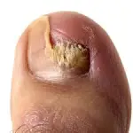 ১ পিছ নখ রিপেয়ার অয়েল - টো-নেইল প্লাস