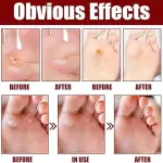 Foot Corn Removal Extra Strengthen Gel(10 ML)