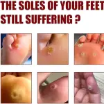 Foot Corn Removal Extra Strengthen Gel(10 ML)