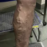 OUHOE Varicose Veins Spray