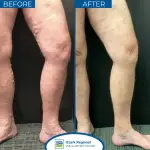 OUHOE Varicose Veins Spray