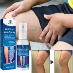 OUHOE Varicose Veins Spray